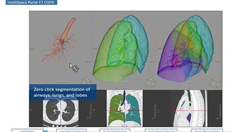 Miniatura wideo CT Copd na youtube