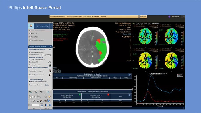 Miniatura wideo na youtube CT mózgu