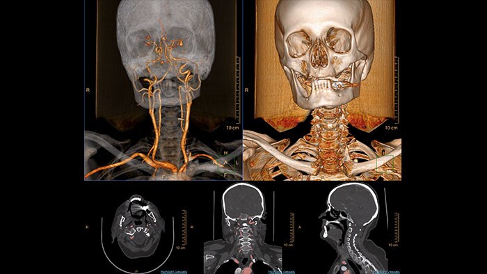 Aplikacja AVA Stent Planning — miniatura