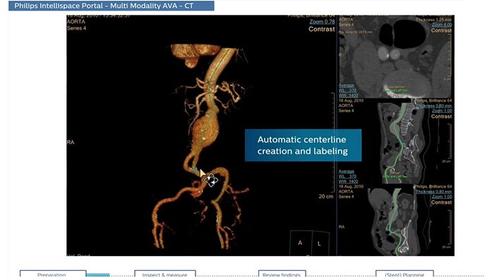 Aplikacja Multi Modality Advanced Vessel Analysis — miniatura klipu wideo w serwisie YouTube