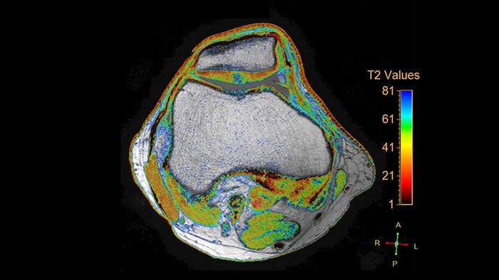 Aplikacja Cartilage Assessment — miniatura