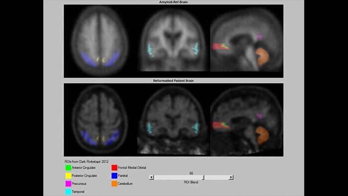 Miniaturka NeuroQ Amyloid