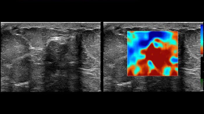 Aplikacja Q-App Elastography Analysis — miniatura