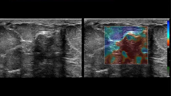 Aplikacja Q-App Elastography Quantification