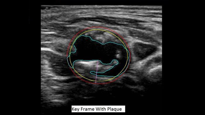 Aplikacja Q-App Vascular Plaque Quantification — miniatura