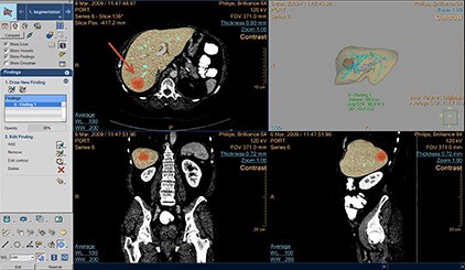 multi-modality-tumor-tracking