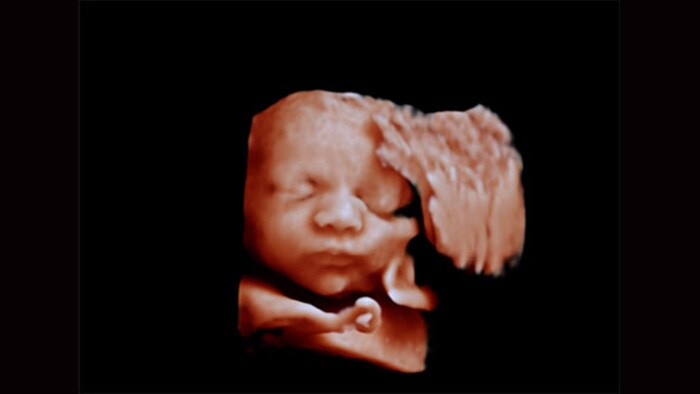 Drugi obraz ultrasonograficzny 3D przedstawiający twarz płodu, pozyskany z wykorzystaniem technologii aReveal