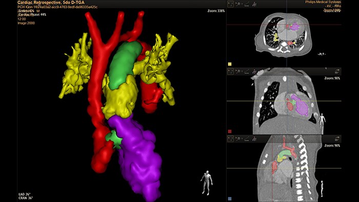 Cardiac retrospective thumb