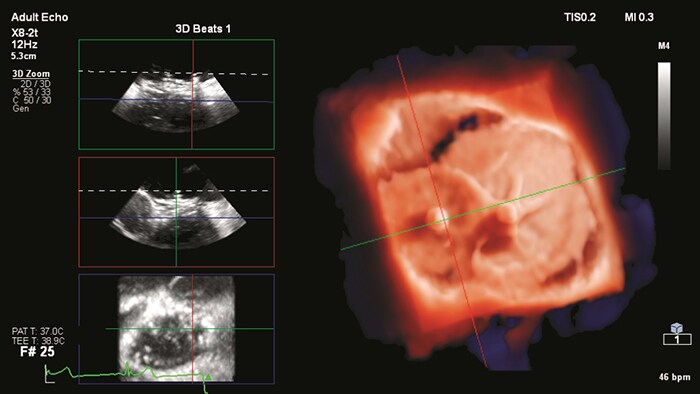 Ultrasonografia wewnątrznaczyniowa (IVUS)