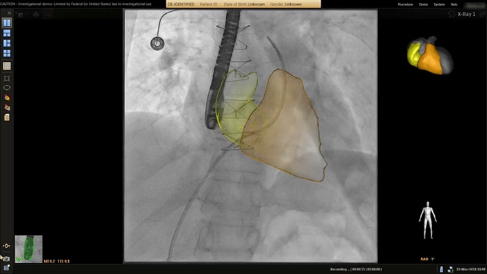 Segmentacja serca z użyciem systemu EchoNavigator