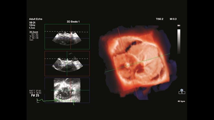 Uwidocznienie anatomii w trybie rekonstrukcji TrueVue