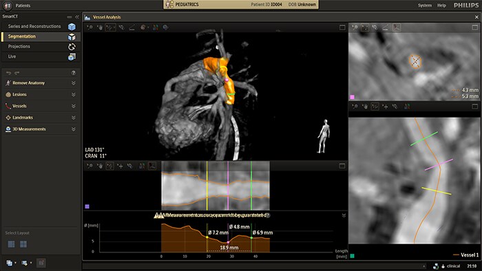 Automatyczna analiza naczyń na obrazie angiografii rotacyjnej