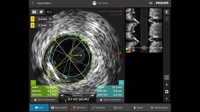 Ultrasonografia wewnątrznaczyniowa (IVUS)