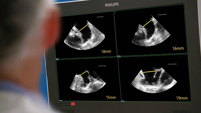 System ultrasonografii interwencyjnej EPIQ CVxi