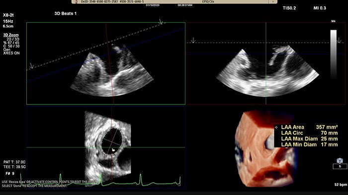 EPIQ CVx -TrueVue Glass with 3D Auto LAA