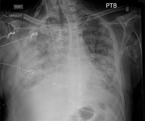 Obraz CXR pozyskany przed intubacją przedstawiający rozlany, obustronny śródpęcherzykowy i śródmiąższowy obrzęk płuc