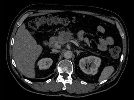 Obraz uzyskany z użyciem aparatu IQon Spectral CT