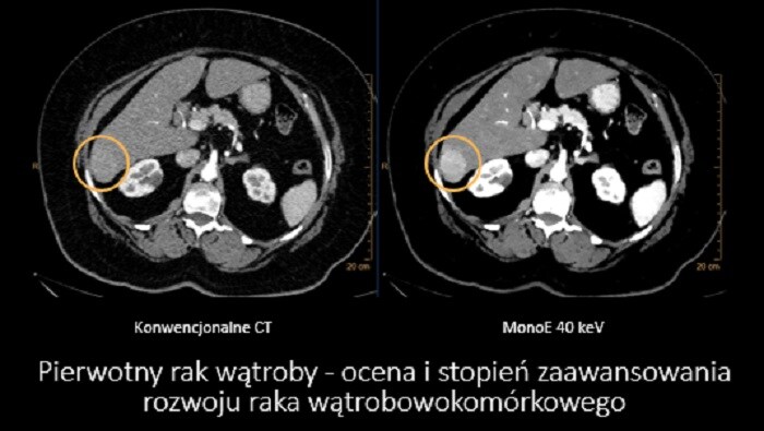 spectralny detektor onkologia