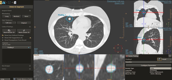 oparta na sztucznej intelifencji aplikacja do detekcji guzk&oacute;w płucnych