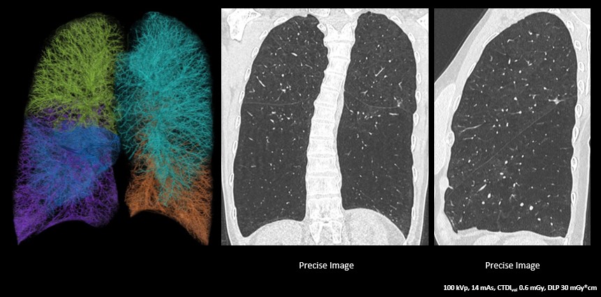 badanie płuc dawka jedyne 0,42mSV dzięki algrorytmowi Precise Image