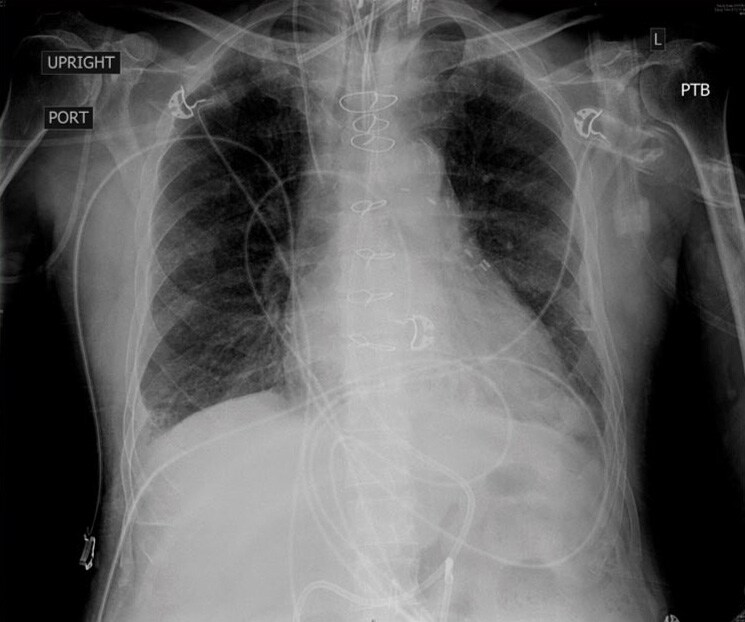 RTG klatki piersiowej wykonane godzine po intubacji (otwiera się w nowym oknie)