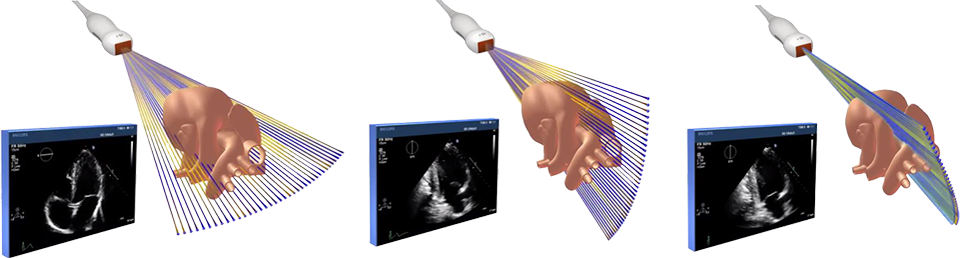 Przykładowy obraz Live xPlane pozyskany z wykorzystaniem technologii ultrasonograficznej xMatrix