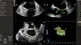 Mitral Valve Navigator provides calculations in just a few easy and quick steps.