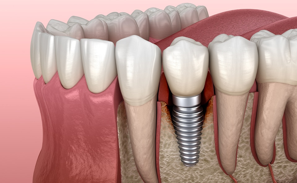 Jak wygląda leczenie implantologiczne zębów - montaż implantu zębowego w szczęce.