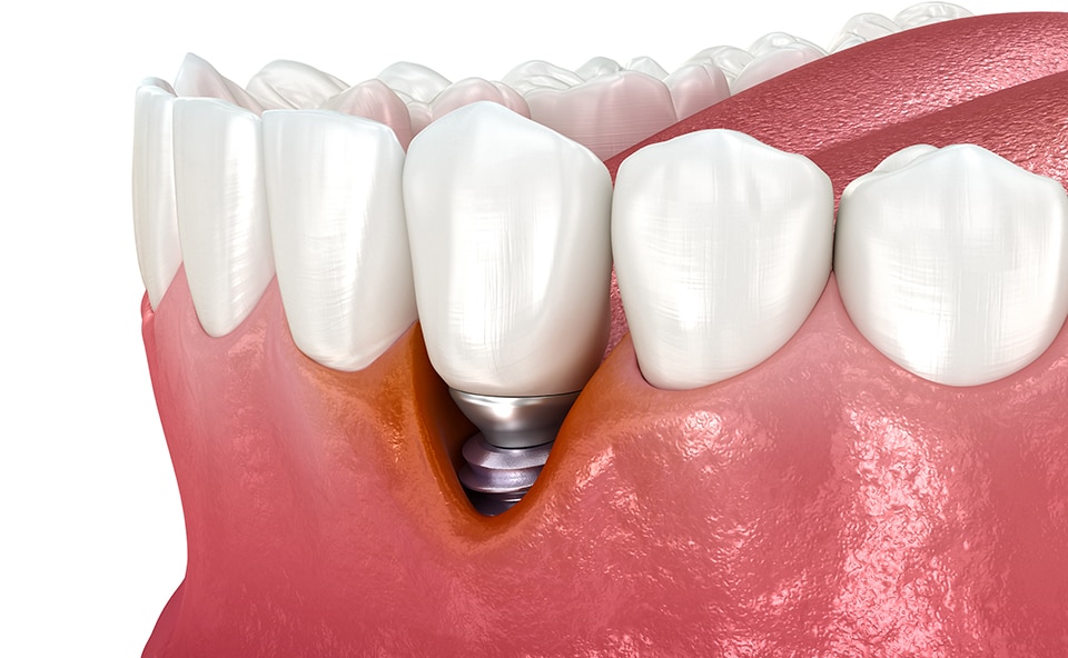 Jak wyglądają objawy i początki problemu z Periimplantitis w jamie ustnej przy implancie zębowym.