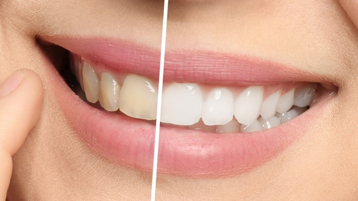 Profesjonalne wybielanie – w jaki sposób zadbać o bielsze zęby pacjentów?