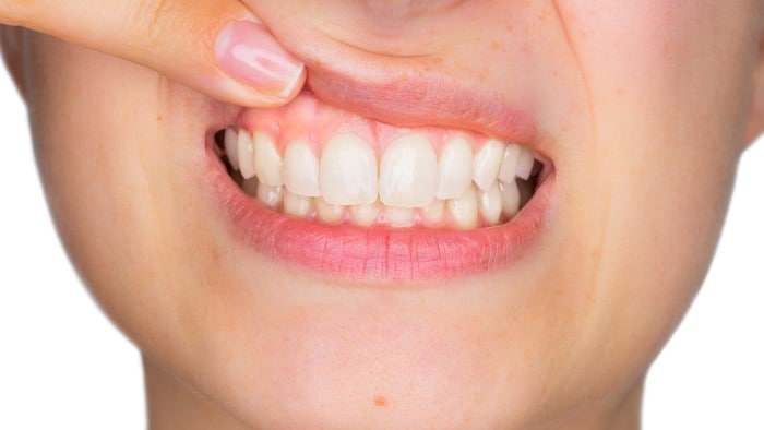 Recesja, cofanie się dziąseł i odsłonięte szyjki zębowe - przyczyny, jak leczyć i zapobiegać