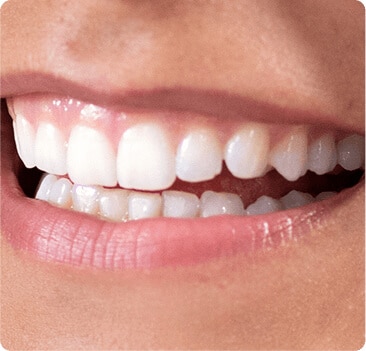 Dokładnie wyczyszczone zęby i przestrzenie międzyzębowe, przy użyciu irygatora do zębów Philips.